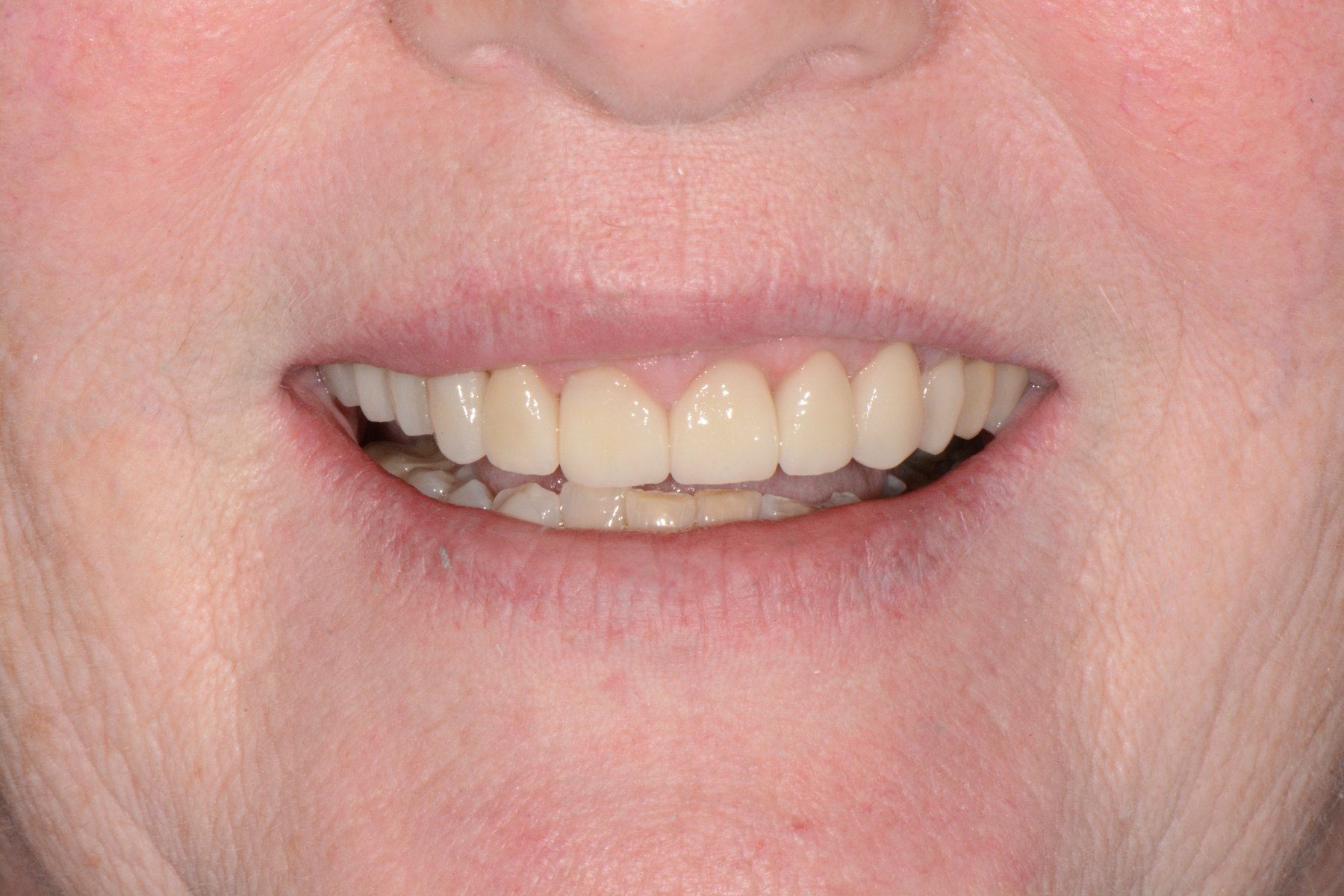 Close-up of patient's smile showing upper dental crowns at Smile to Me