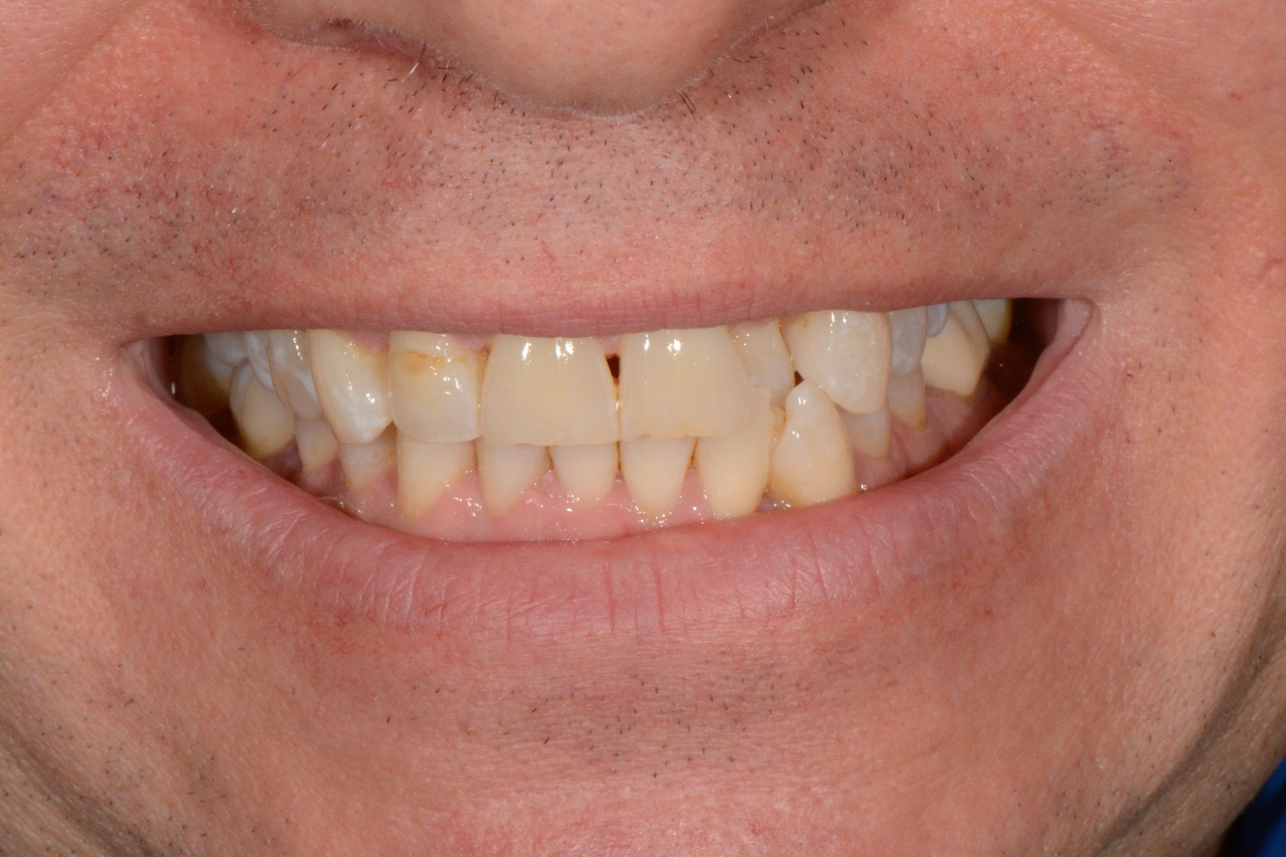 Close-up of patient's smile showing teeth discoloration before treatment