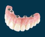 Implant-supported dental bridge with visible attachment posts, European Denture Center