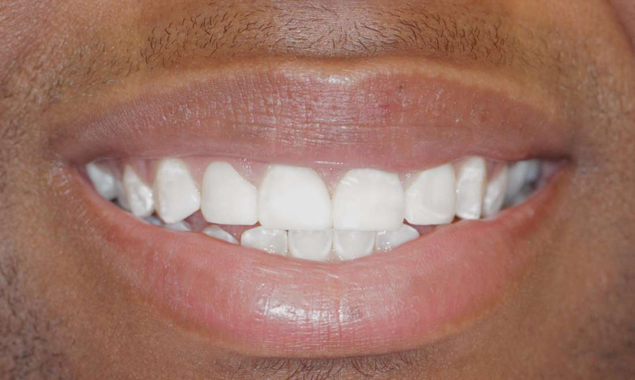 Close-up after photo showing repaired, even front teeth following dental treatment