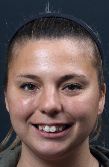 Before photo of a patient's smile showing teeth prior to dental treatment at Dental Care Stamford