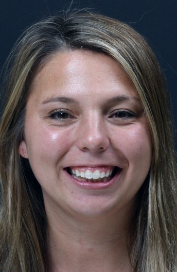 After photo of a patient's improved smile following treatment at Dental Care Stamford